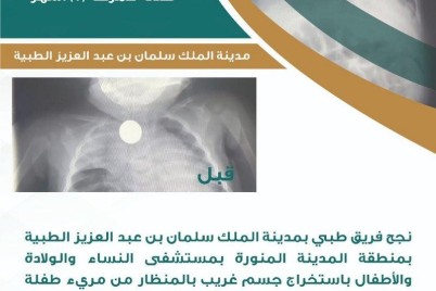طبية الملك سلمان بن عبدالعزيز بالمدينة المنورة تنجح في استخراج جسم غريب بالمنظار من مريء طفلة